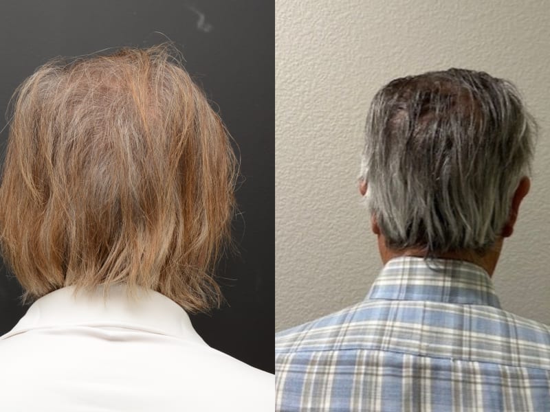Patient B &mdash; NeoGraft FUE before and after