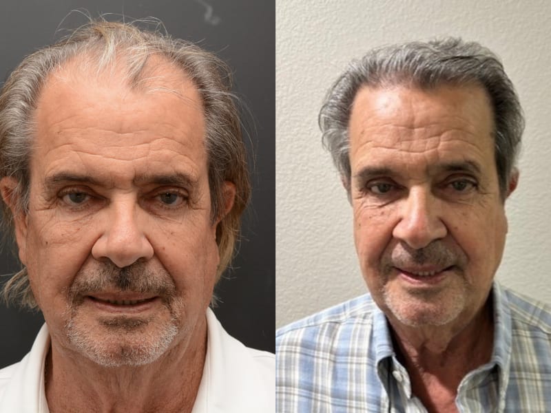 Patient C &mdash; NeoGraft FUE before and after