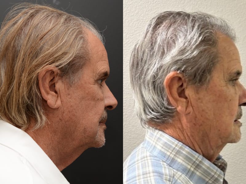 Patient D &mdash; NeoGraft FUE before and after