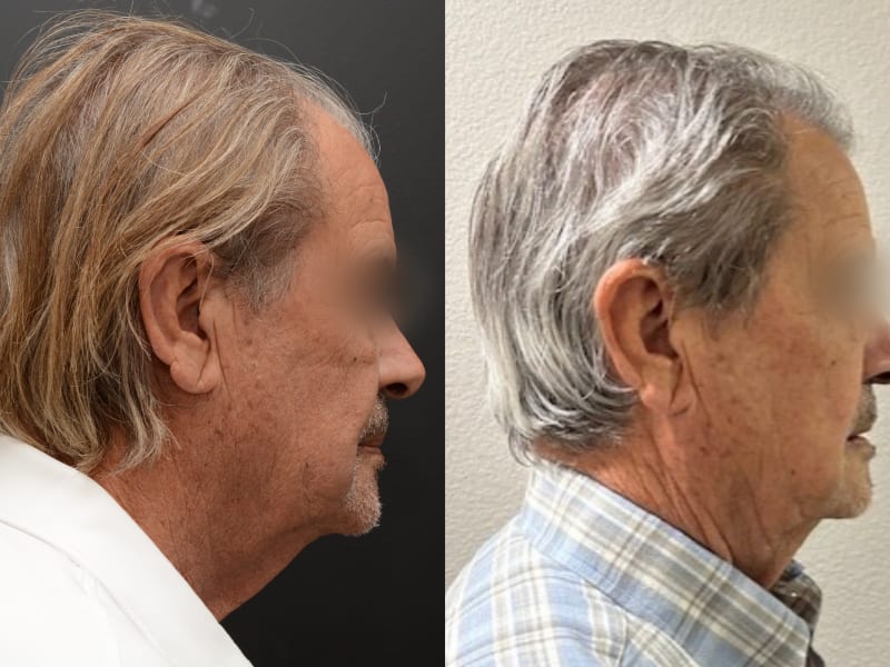 Right profile — NeoGraft FUE hair transplant before and after