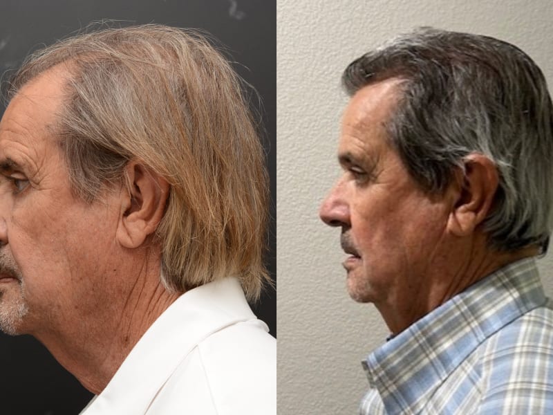 Patient E &mdash; NeoGraft FUE before and after