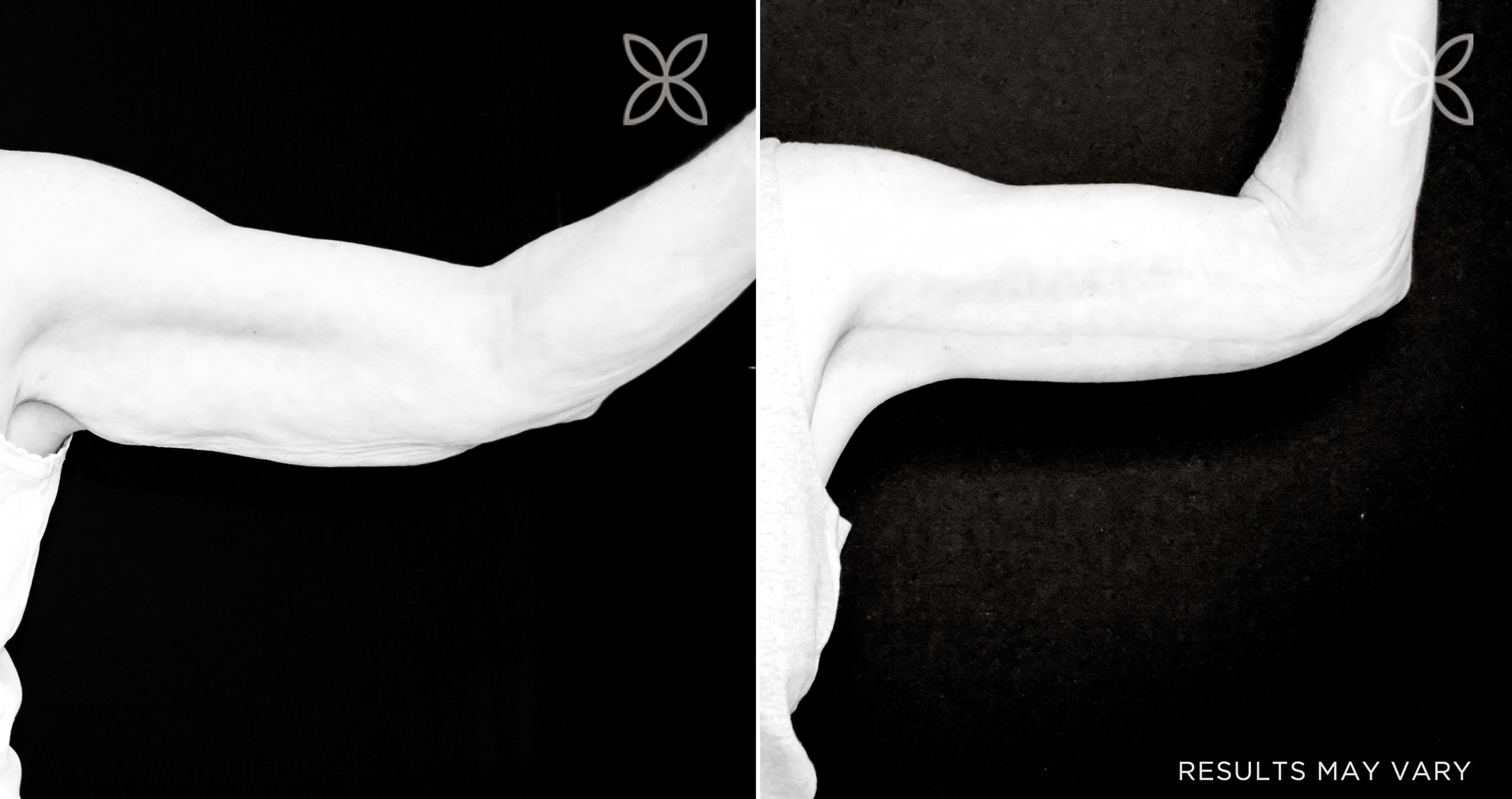 Arm Lift