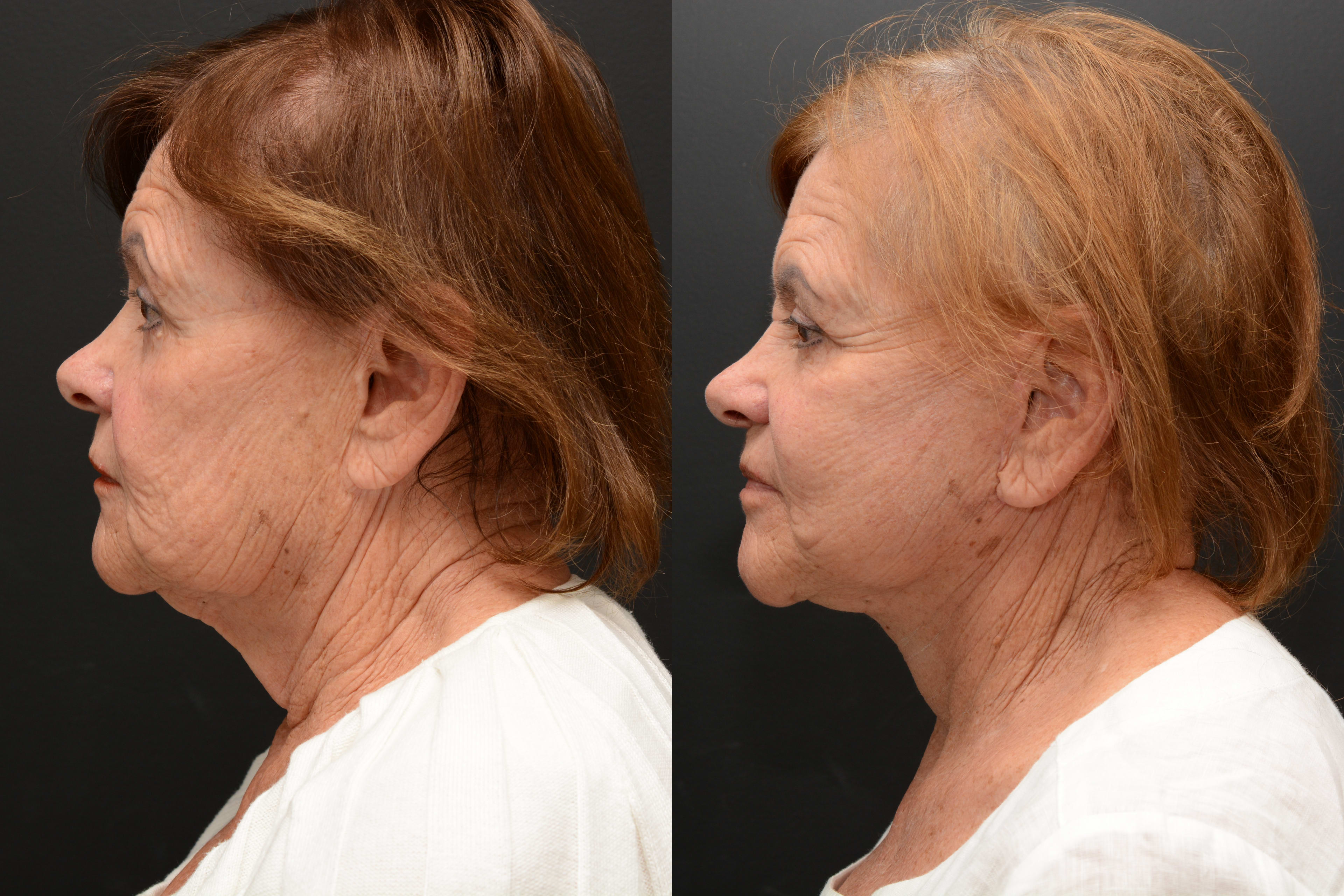 Facelift