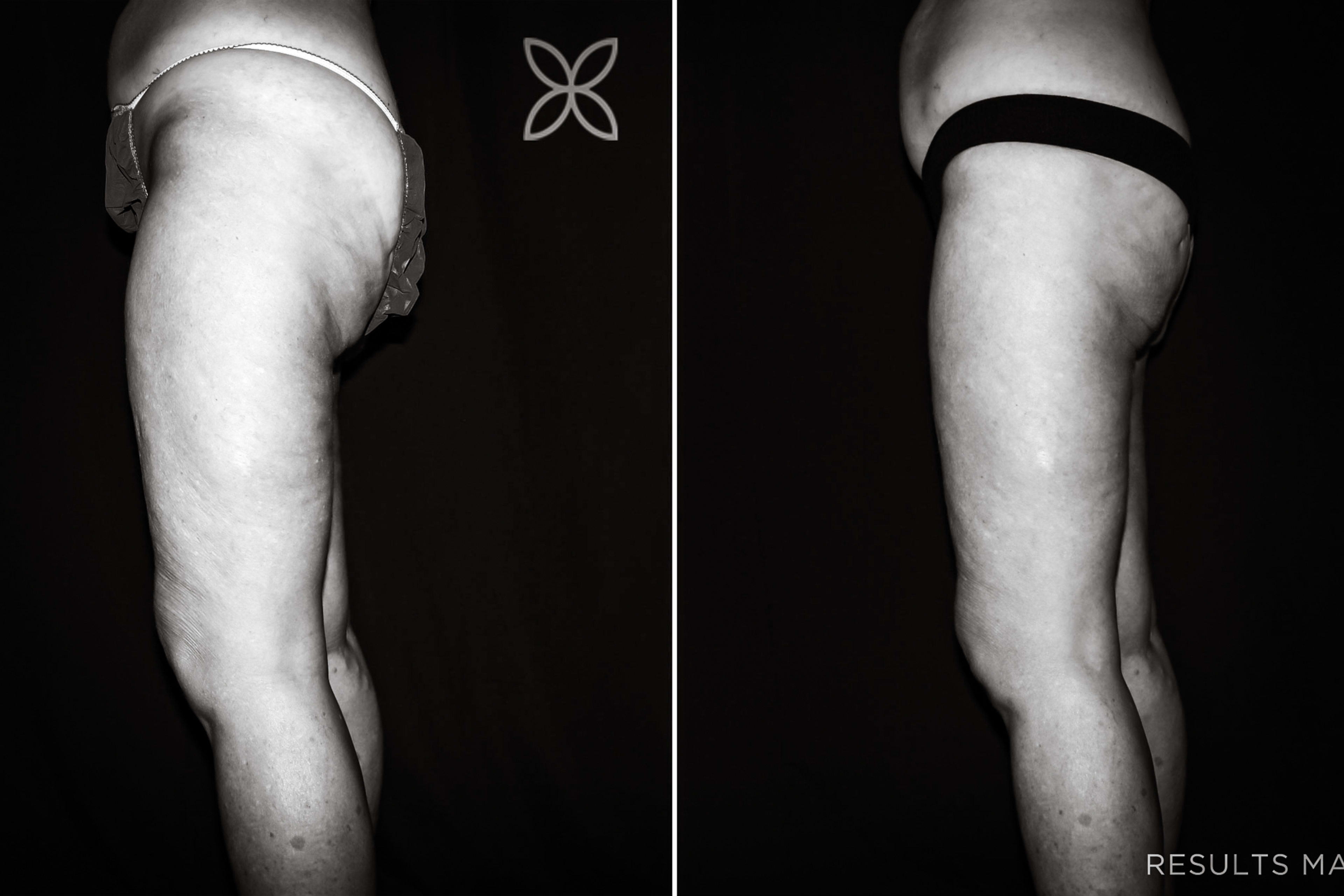 Thigh Lift