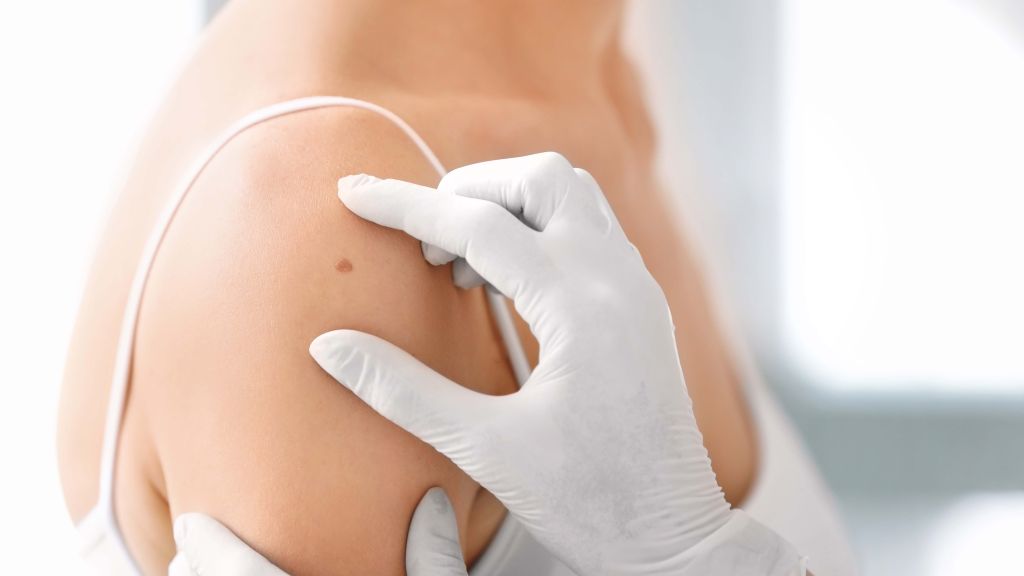 Uma vacina personalizada para melanoma reduziu o risco de recorrência do câncer após cinco anos