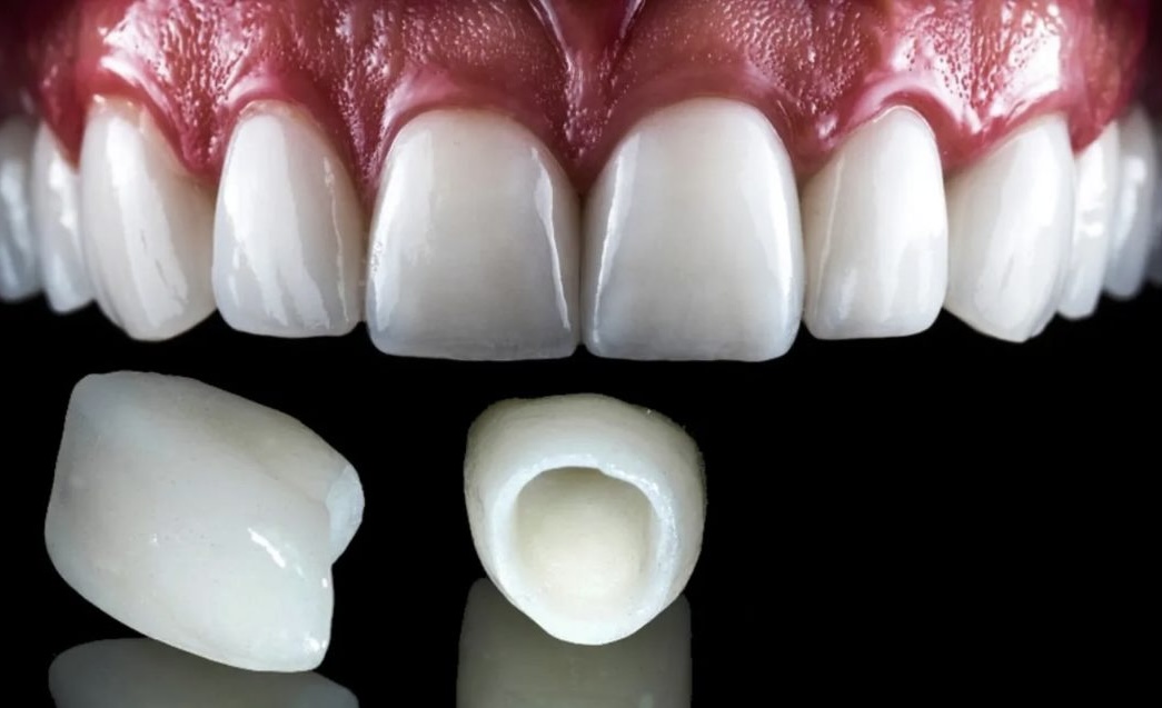 Stomatološka protetika - cirkonijumske krunice