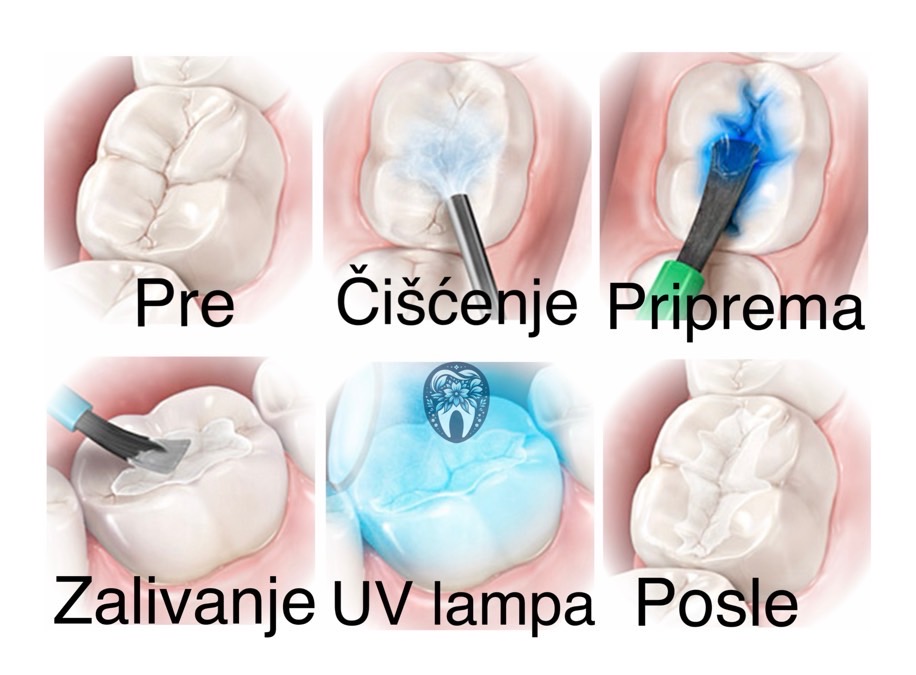 Preventivno zalivanje fisura