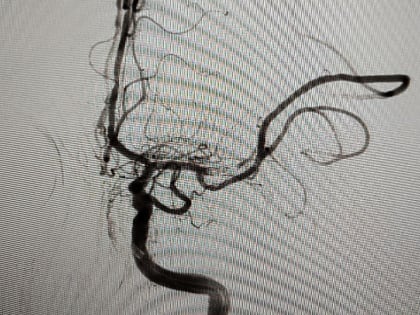 Луганские врачи провели первые пять операций по извлечению тромба из артерии