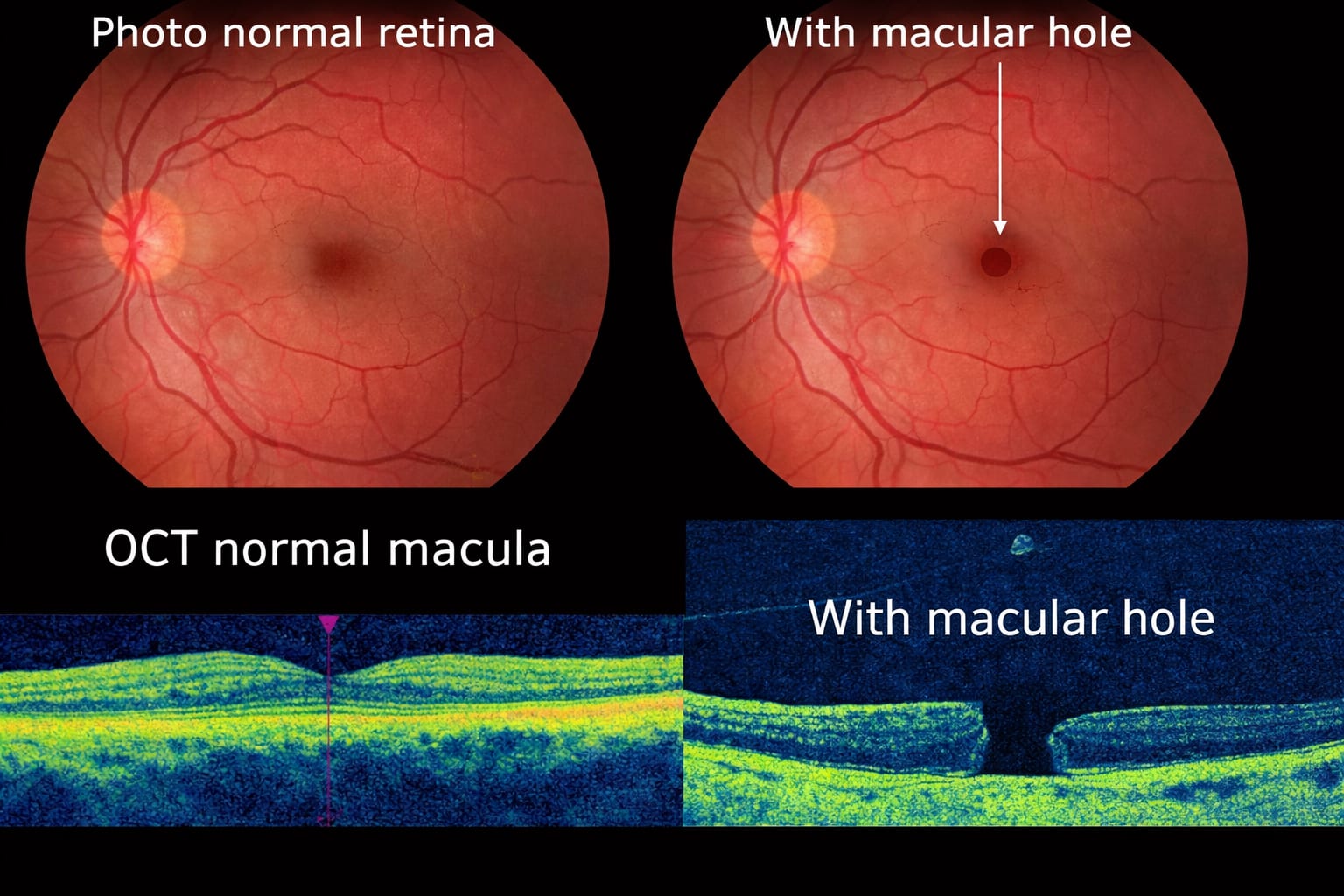 OCT scan showing macular hole