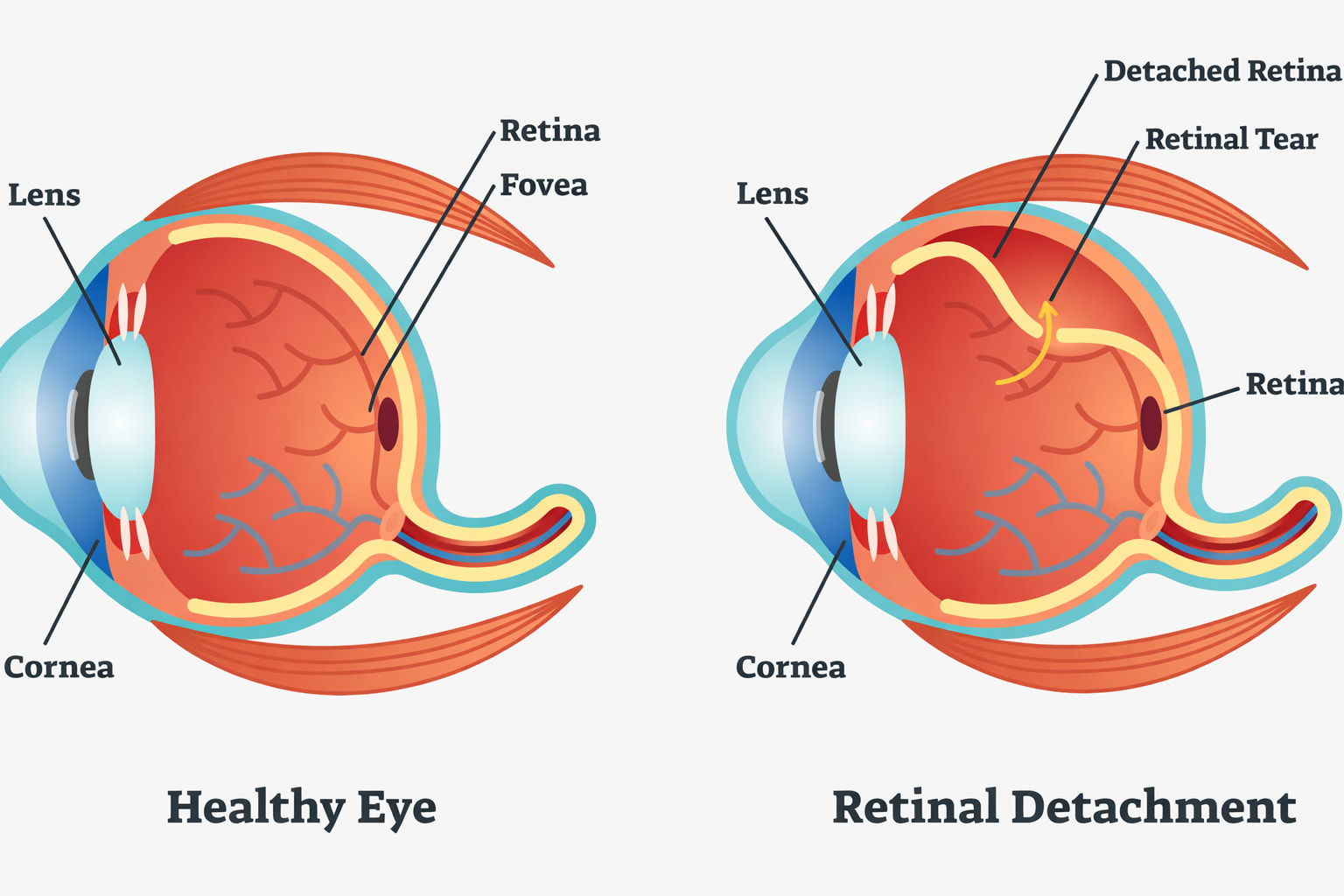 OCT scan showing vitreous detachment