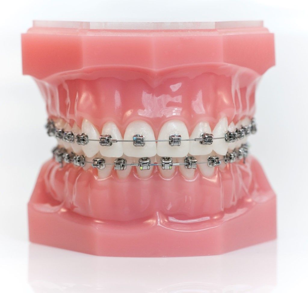 Best dental Ceramic brackets supplies in hyderabad dilsuknagar