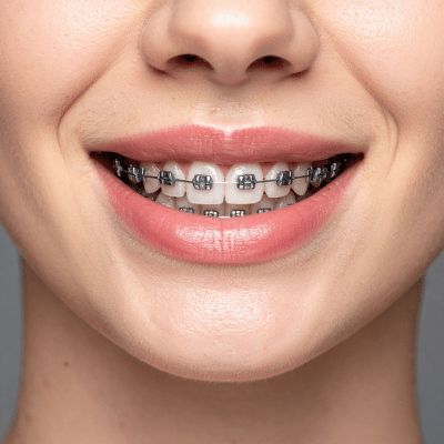 Best dental Orthodontics supplies in hyderabad dilsuknagar