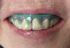 SmileLine Dental Marker - Image 2 of 0
