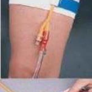 Bird & Cronin Cath-Mate Â® II Leg Stap