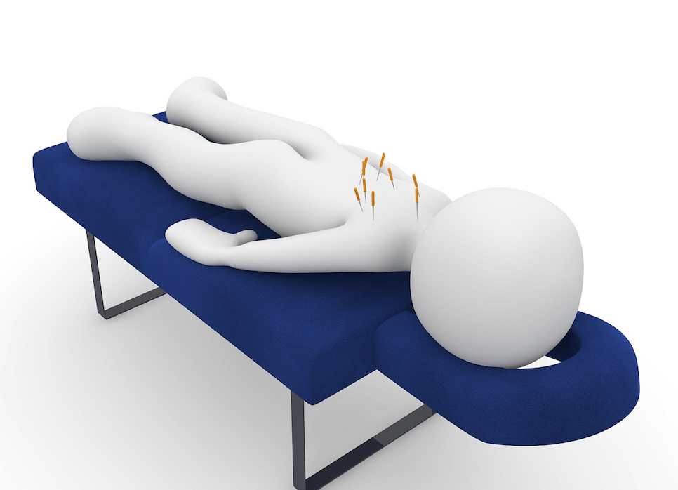 acupuncture