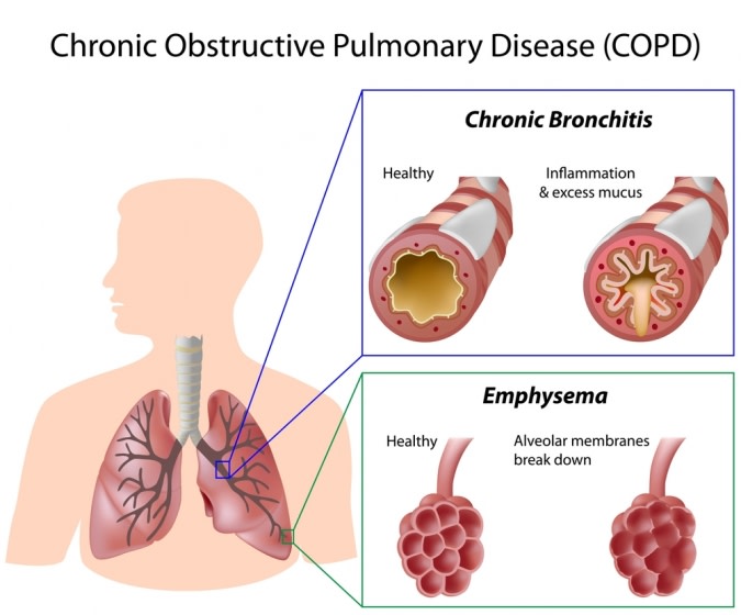 COPD information graphic