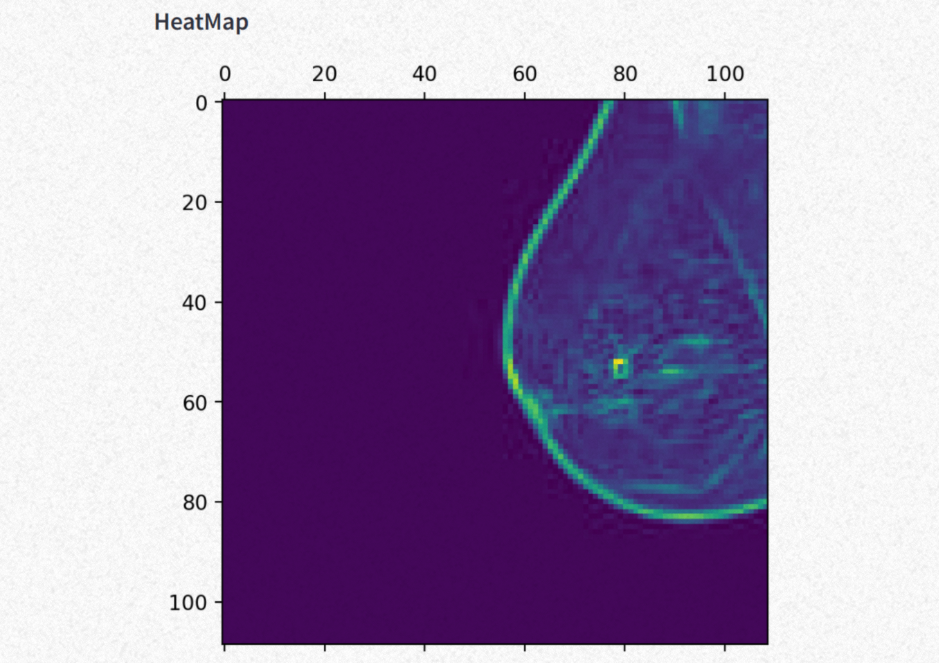 Breast Cancer AI Model