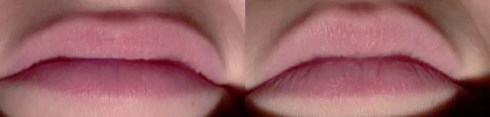 Avant Après du sérum lèvre repulpant