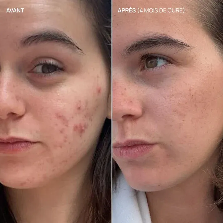 Example de avant-après l'utilisation de Pure Glow pendant 4 mois
