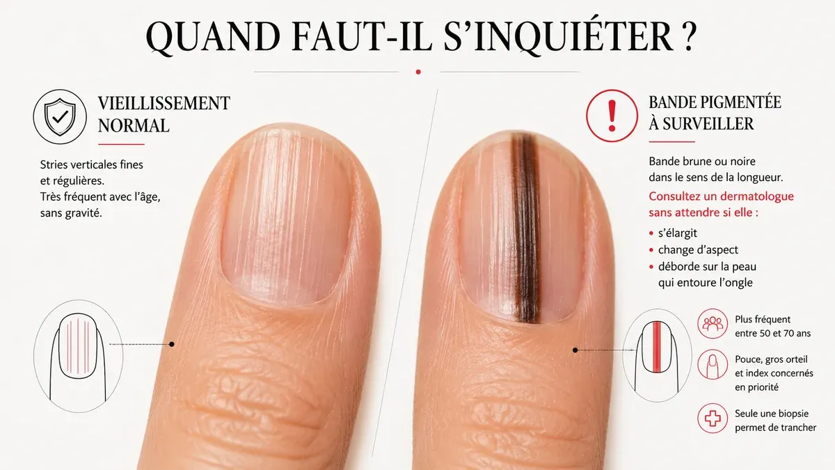 Infographie : Ongles striés et cancer, ce qu'il faut vraiment surveiller