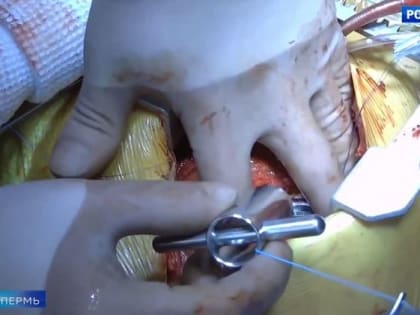 Пермские врачи впервые в Приволжье вживили ребенку устройство, которое помогает работать левому желудочку сердца