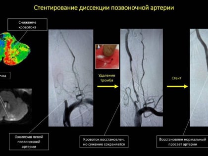 Хирурги Прикамья провели уникальную для России операцию