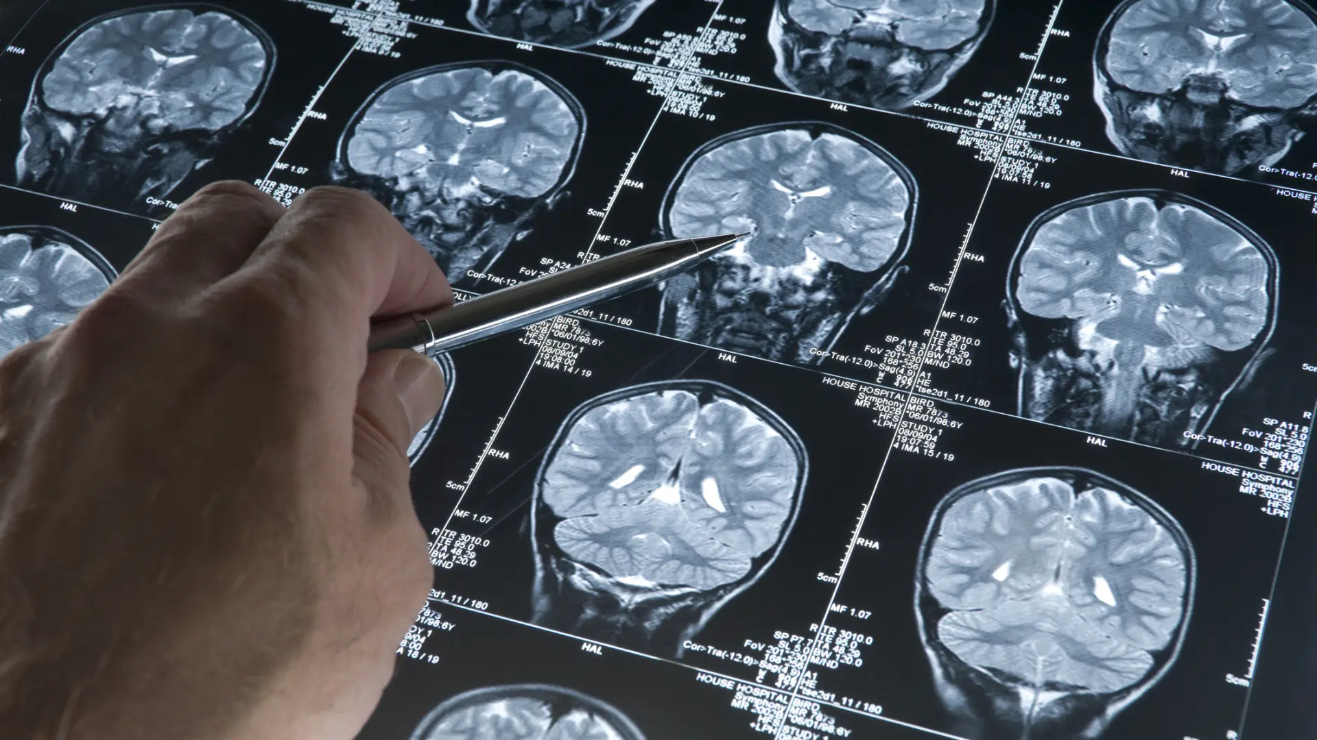 Un ensayo internacional logra reducciones y desapariciones completas de tumores en pacientes con cáncer avanzado mediante amivantamab subcutáneo