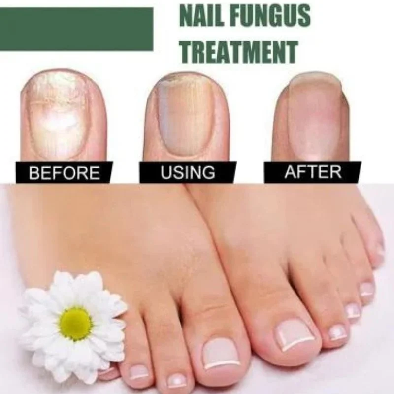 Fast Nail Care Serum  Nail Repair Essence for Fingernails & Toenails  Natural Nail Nourishing Formula