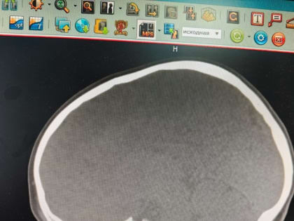 Чебоксарские хирурги рассказали, какой модный тренд оказался опасным