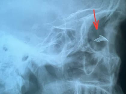 В Чебоксарах офтальмологи спасли глаз пациенту после травмы при строительных работах