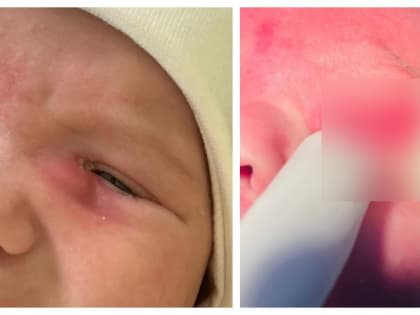 Чебоксарские офтальмологи экстренно прооперировали двухмесячного ребенка