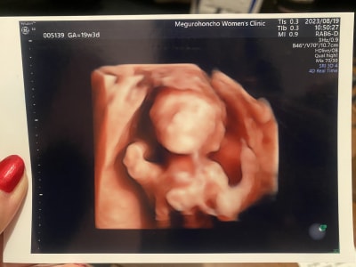 First 4D ultrasound picture!