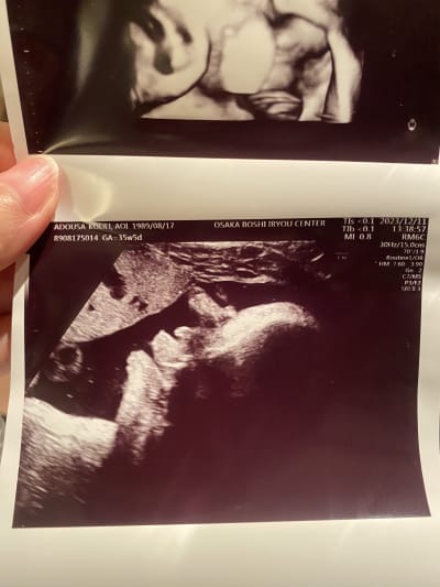 The side of his face on the 35th week