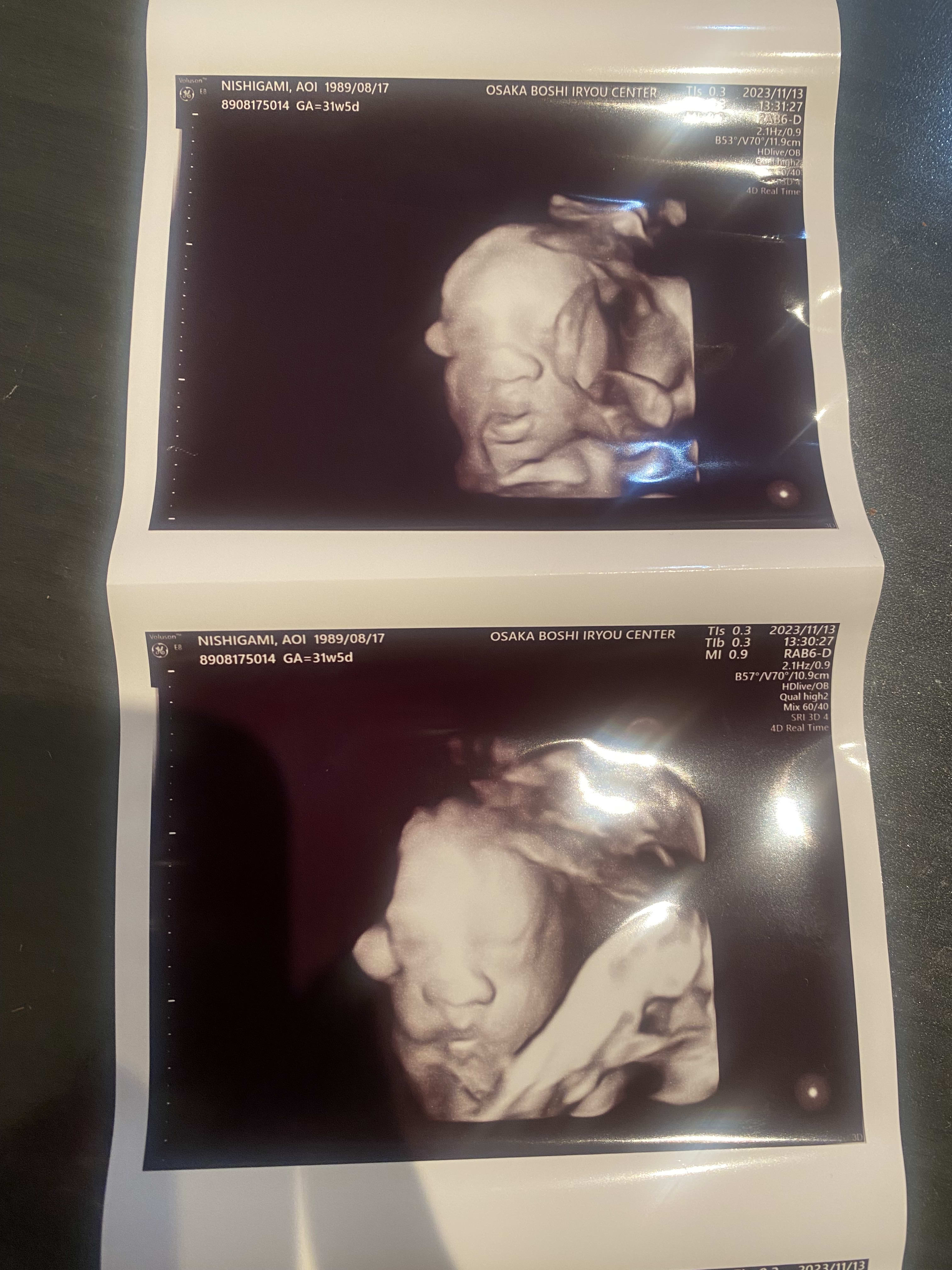 31 week! Big nose and cute lips