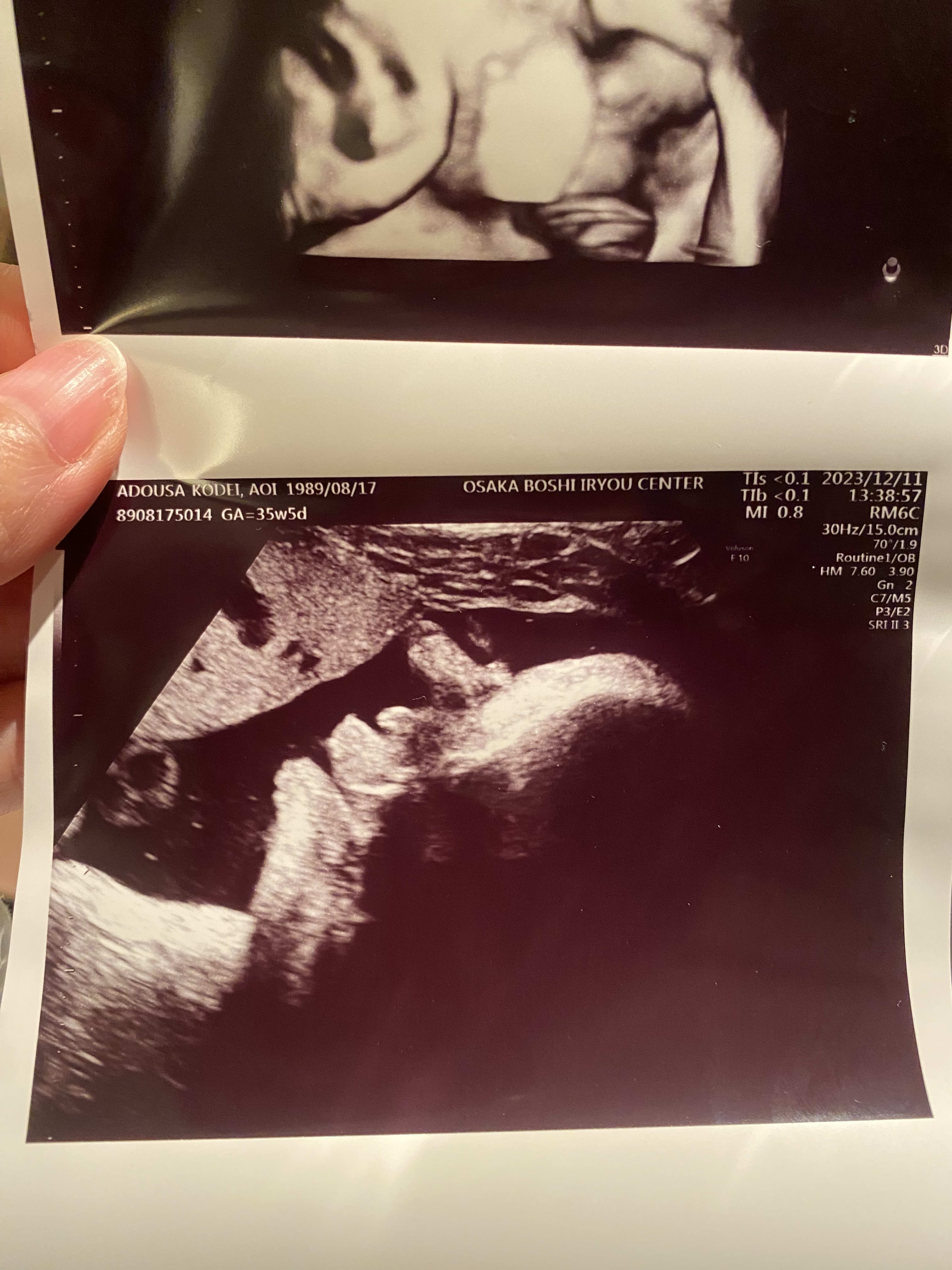 The side of his face on the 35th week