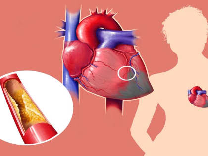 Острый коронарный синдром - что делать и как лечиться