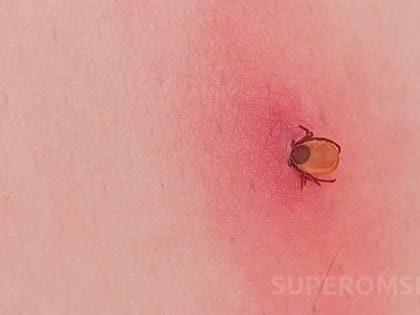 Смертельные укусы: три человека погибли от клещевых инфекций в Новосибирской области