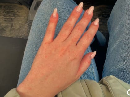 Этого не может быть! Реальные истории омичей, которые боятся солнца