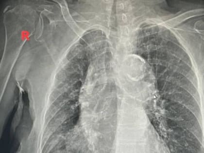 Медики спасли 100-летнюю омичку с температурой 40 градусов