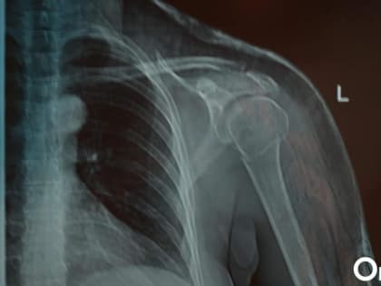 Часто ли можно делать рентген? Разбираем популярные мифы