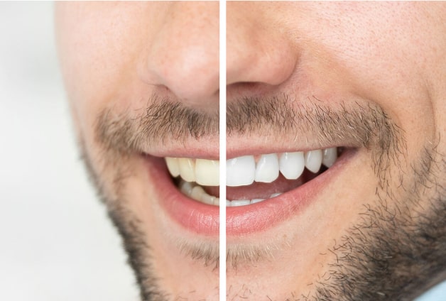 Before and after teeth whitening