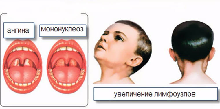 Ангина плаута венсана. Вирус Эпштейна-Барр мононуклеоз. Синдром ангины инфекционный мононуклеоз. Мононуклеоз ротовая полость. Инфекция мононуклеоз Эпштейн Барра.