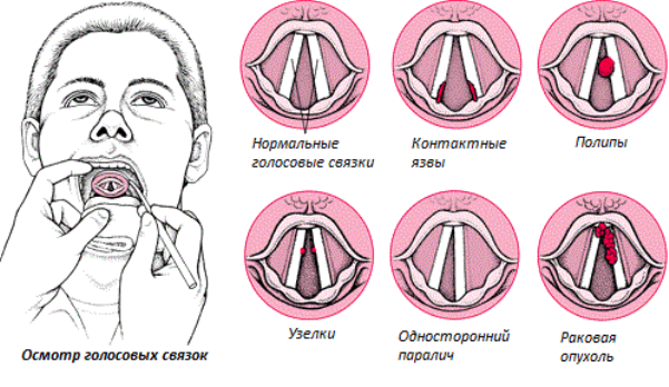 Рак голосовых связок фото