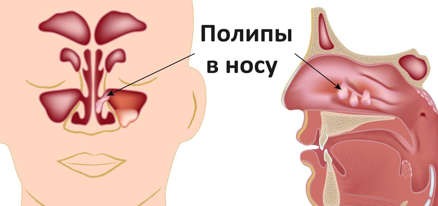 Дышит ртом соплей нет. Полипозного риносинусита.