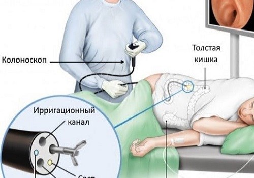 Сделать Колоноскопию Под Наркозом В Москве Цена