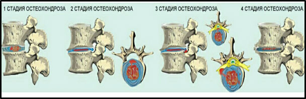 Патогенез остеохондроза позвоночника. Степени остеохондроза. Стадии остеохондроза позвоночника. Стадии формирования остеохондроза. 4 Стадия остеохондроза.