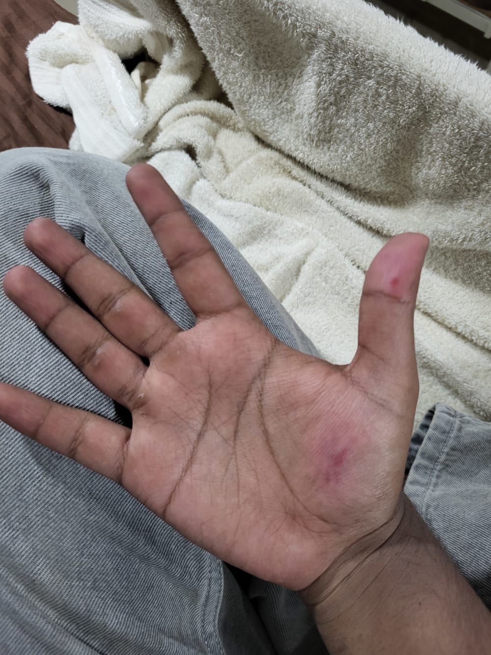 Thumb Sore