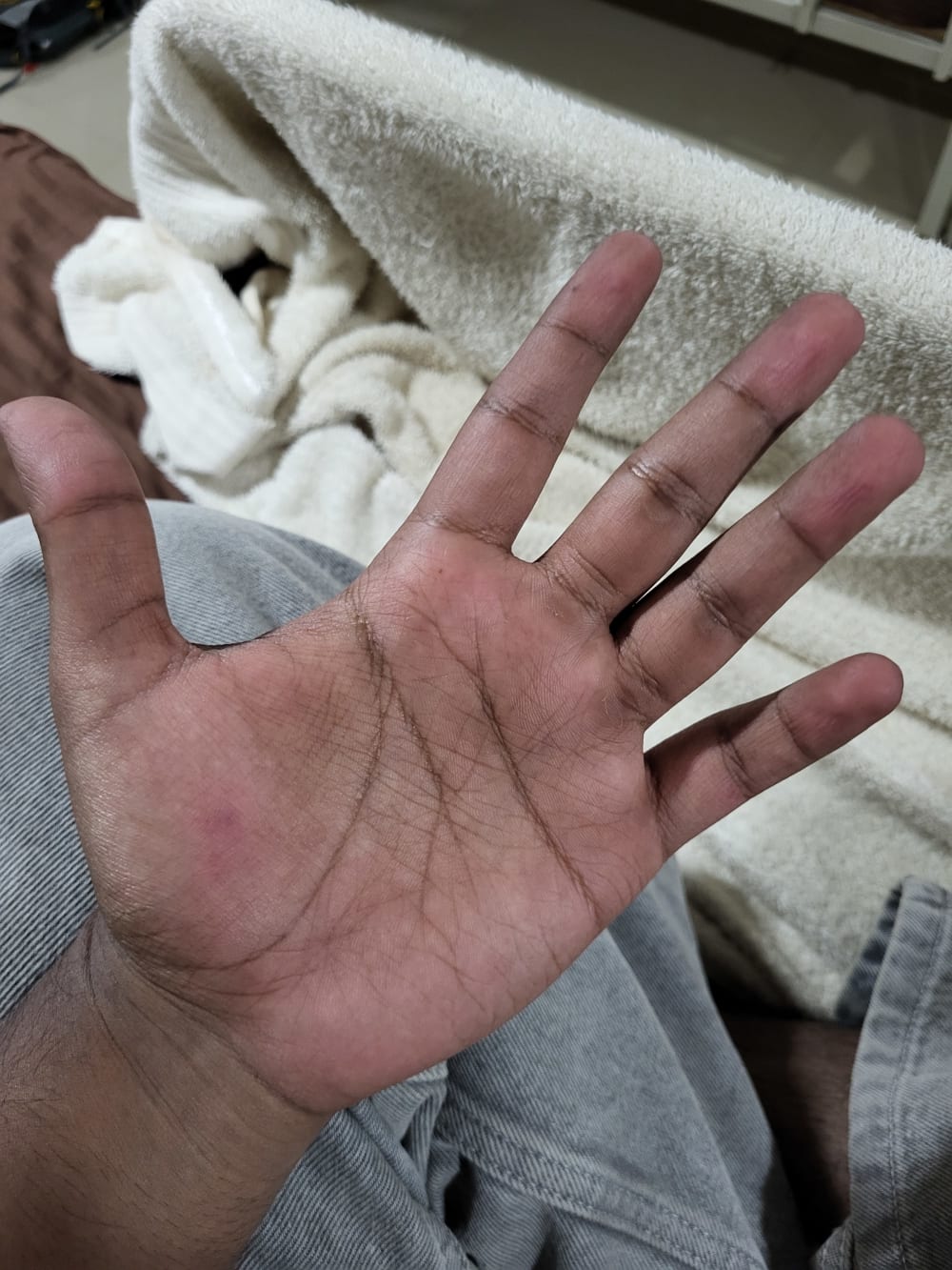 Palm Blister
