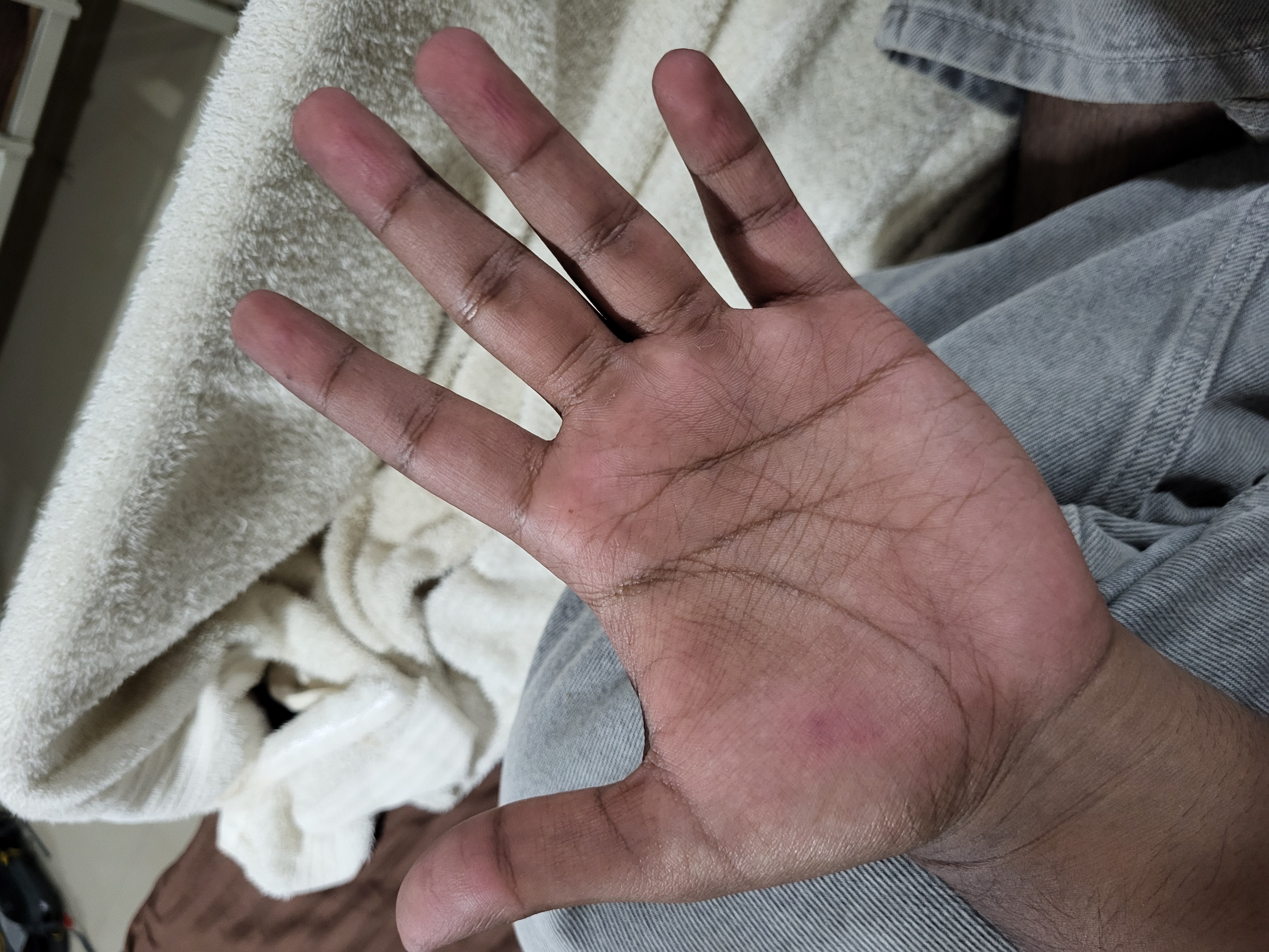 Palm Blister