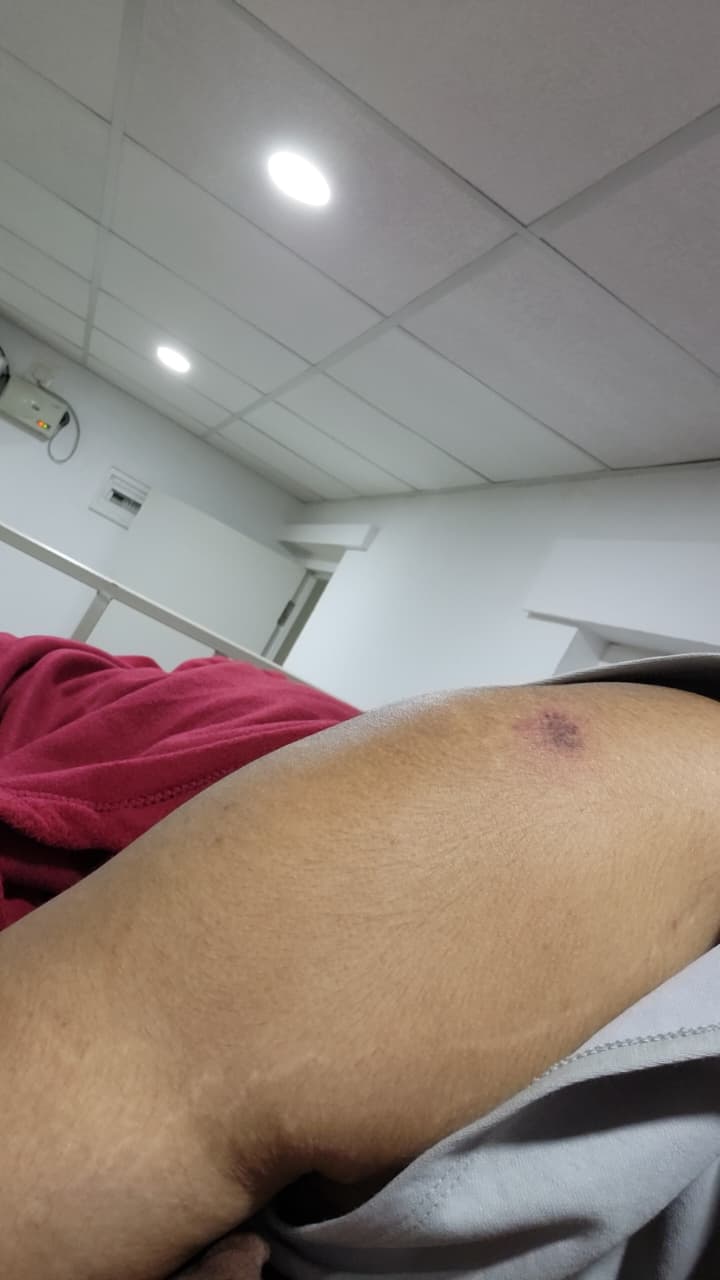 Shoulder Bruise